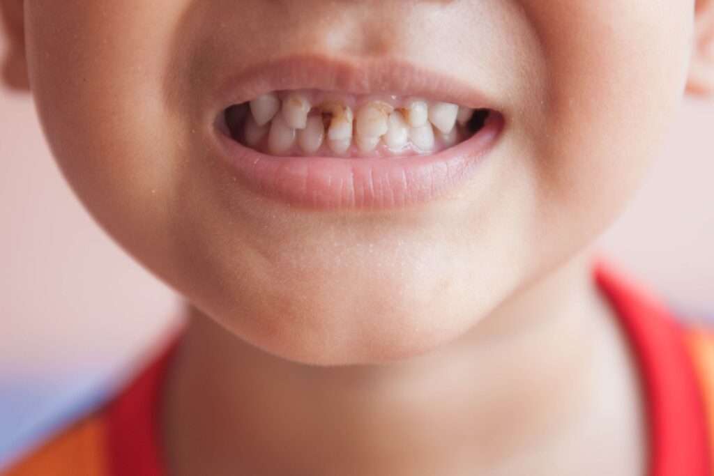 Cavities in Kids and Adults